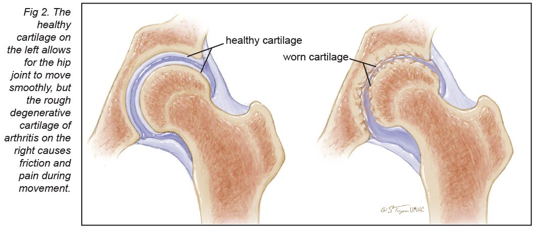 Comparison of healthy versus worn cartilage in the hip joint