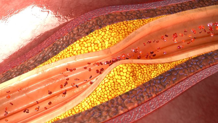 coronary artery plaque 3d illustration