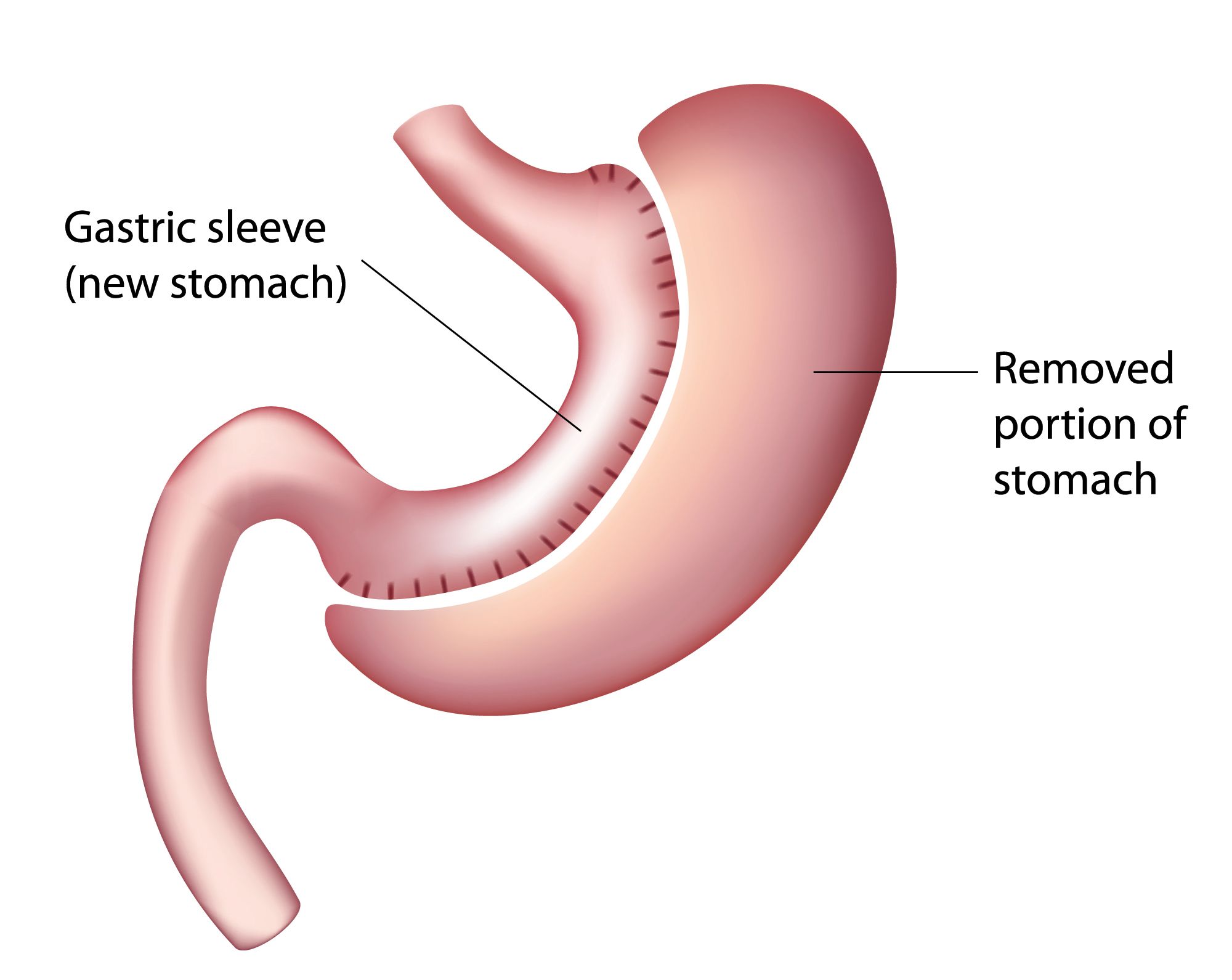 diagram of gastric sleeve surgery