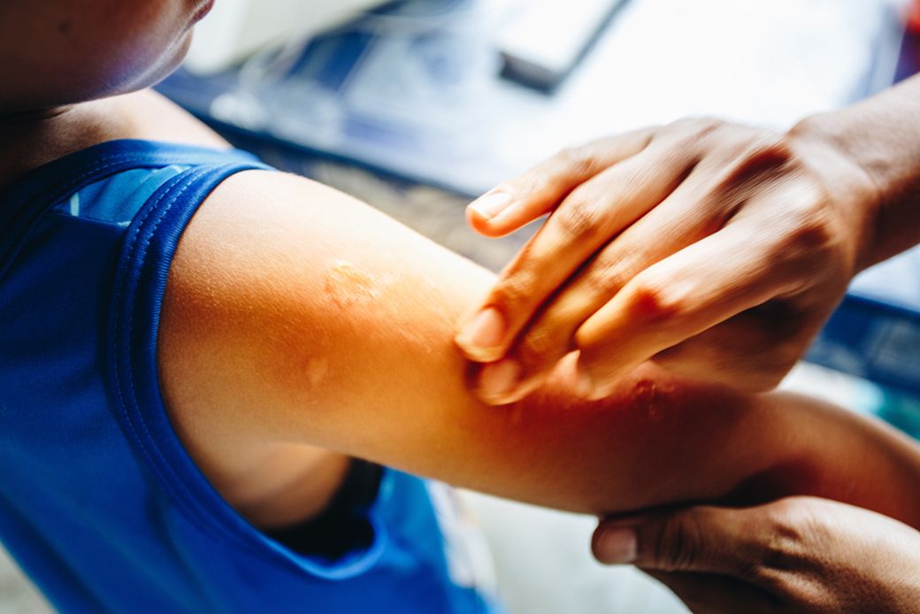 Insect bite on a child's arm