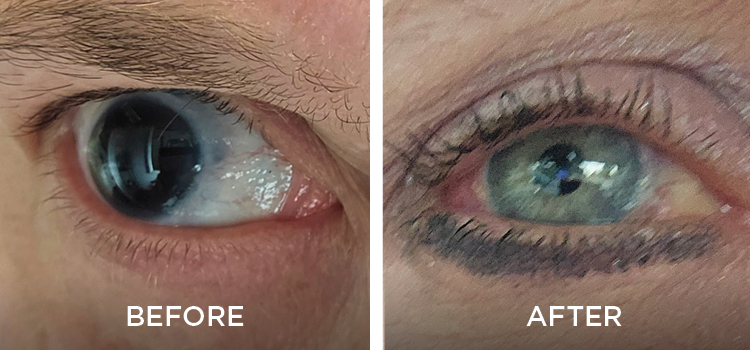 Jennifer’s right iris before implant surgery (left) had almost no ability to regulate light entering her eye. The new implanted iris (right) has a fixed opening to control the amount of light.