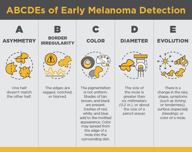 Early signs of skin cancer