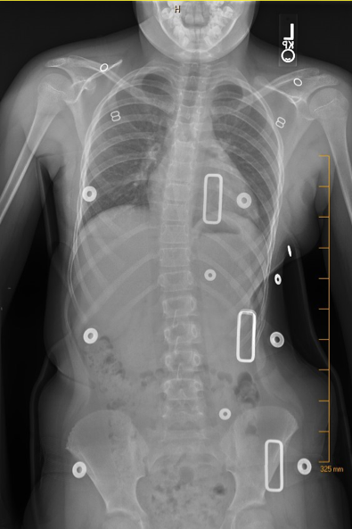After X-ray