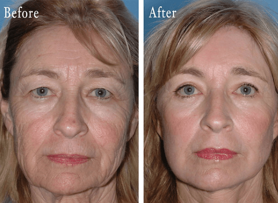 handboeien ik heb honger periodieke Brow and Forehead Lift - MU Health Care