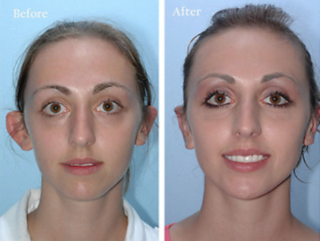 Before and After Ear Surgery