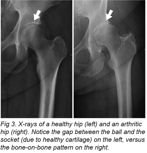 x-ray of hip used to diagnose arthritis or degeneration of the hip joint