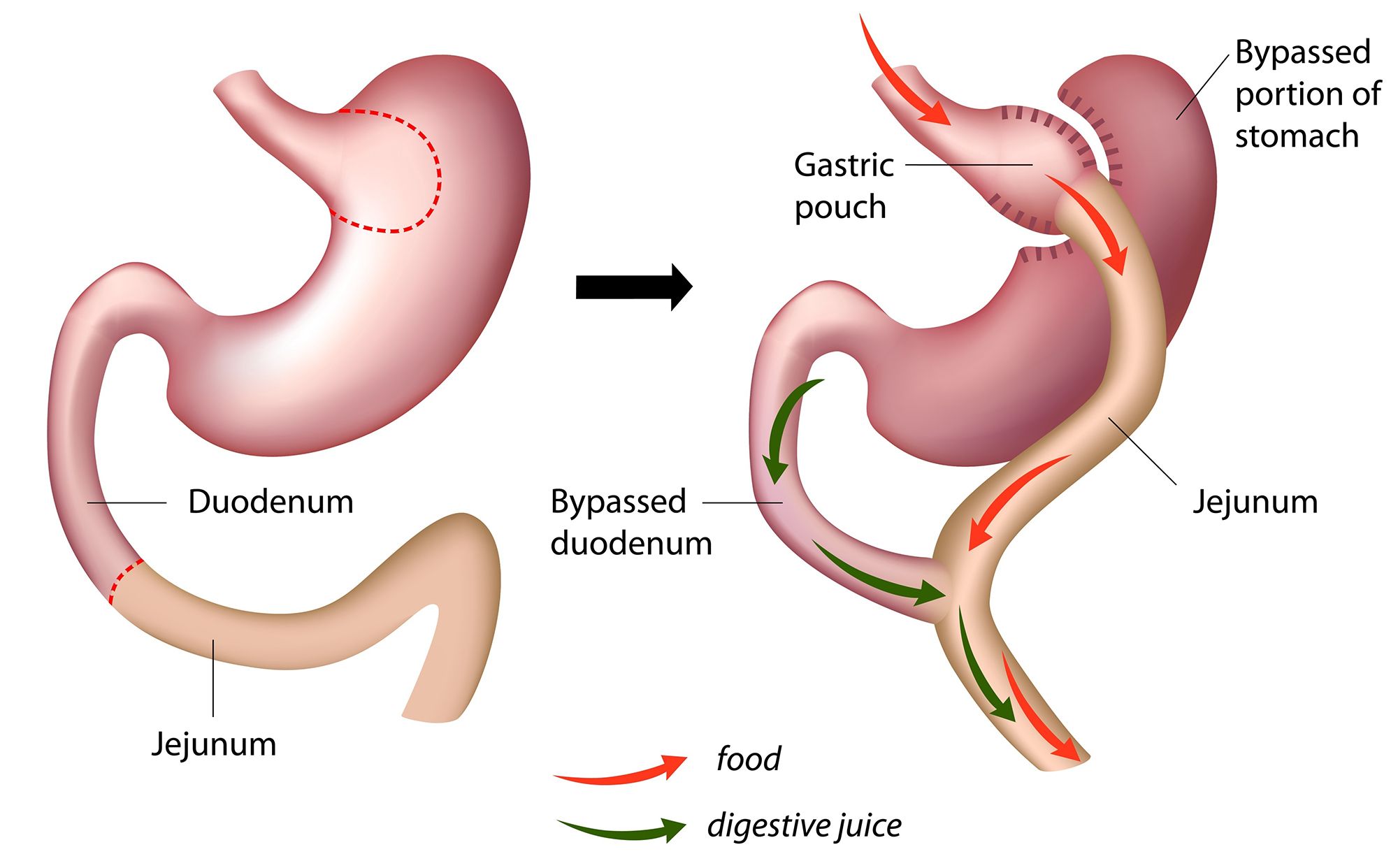 diagram of gastric bypass surgery