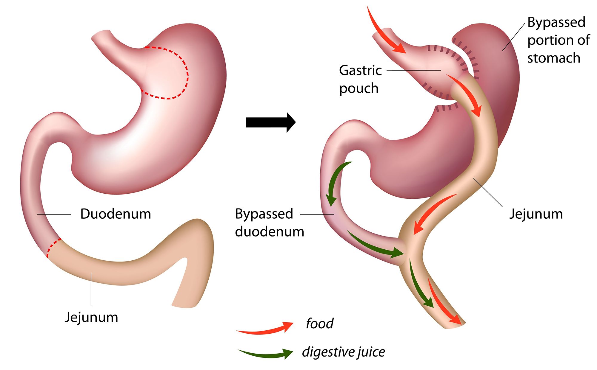 Gastric Bypass