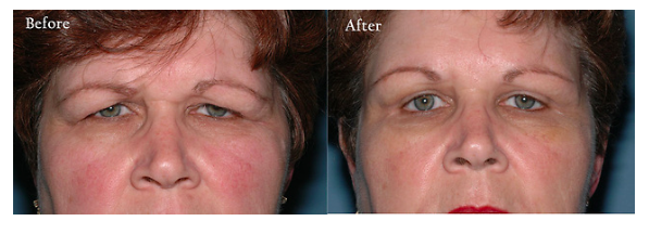 Eyelid surgery