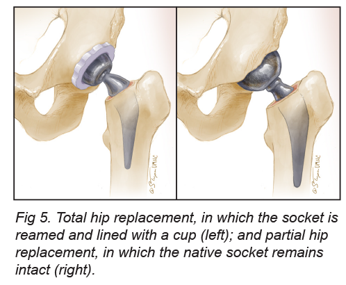 illustration of total and partial hip replacement