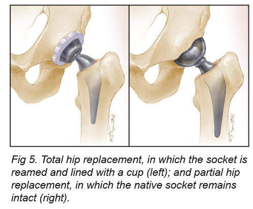 Preoperative Nursing Care For Total Hip Replacement thumbnail