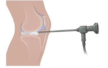 Treating Knee Arthritis , MU Health Care