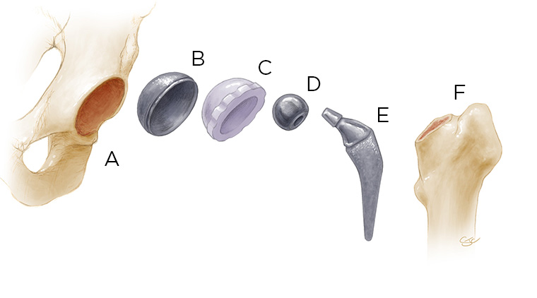 Photo of hip parts and materials