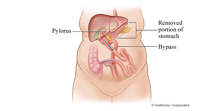 Duodenal surgery