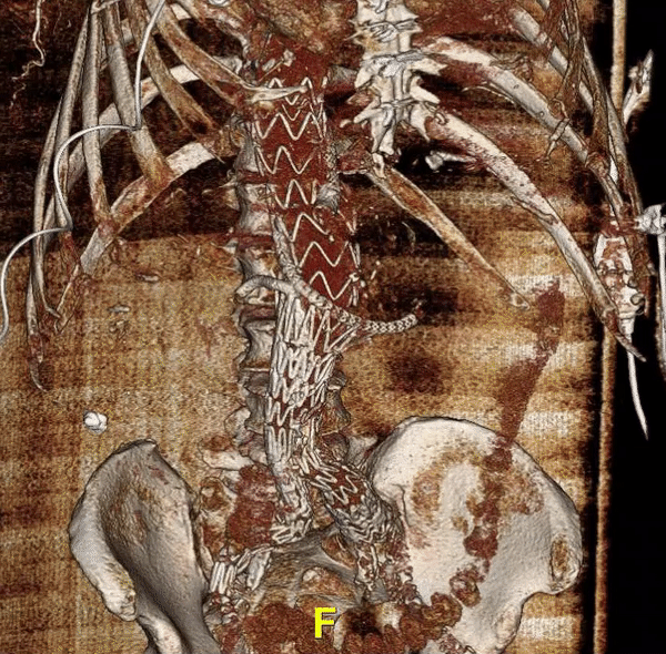 chimney endovascular repair