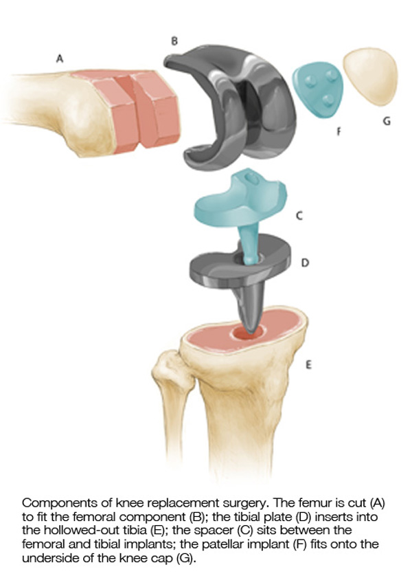 knee replacement diagram knee parts and materials mu health care knee replacement diagram knee parts and materials mu health care