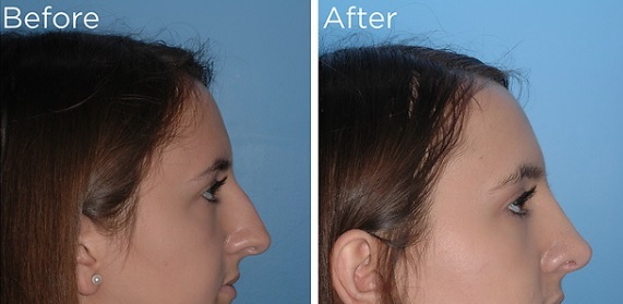 Rhinoplasty Austin Tx