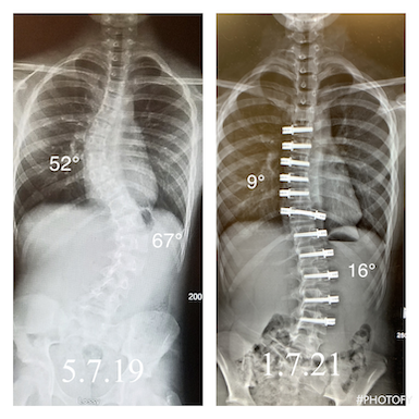 Grier Panzer before and after surgery