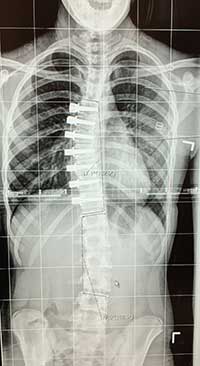 Vertebral Body Tethering