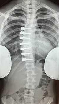 Vertebral Body Tethering
