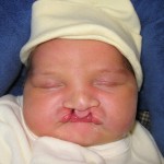 cleft palate