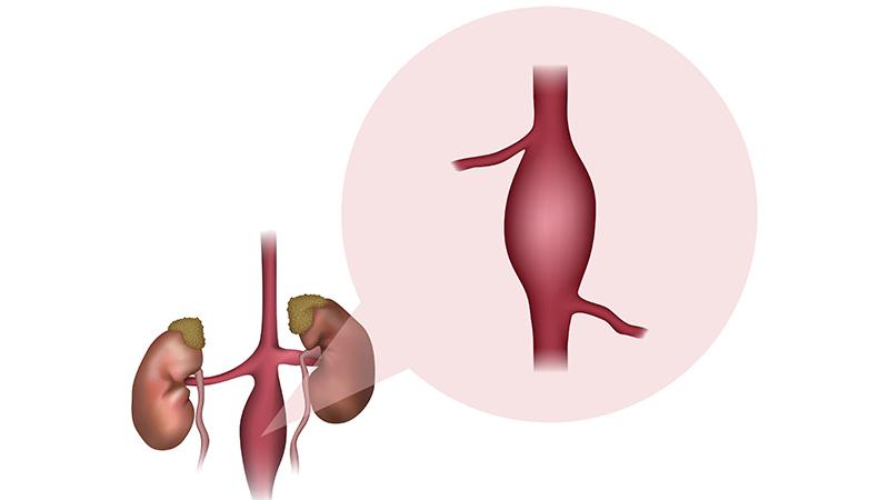 abdominal aortic aneurysm illustration