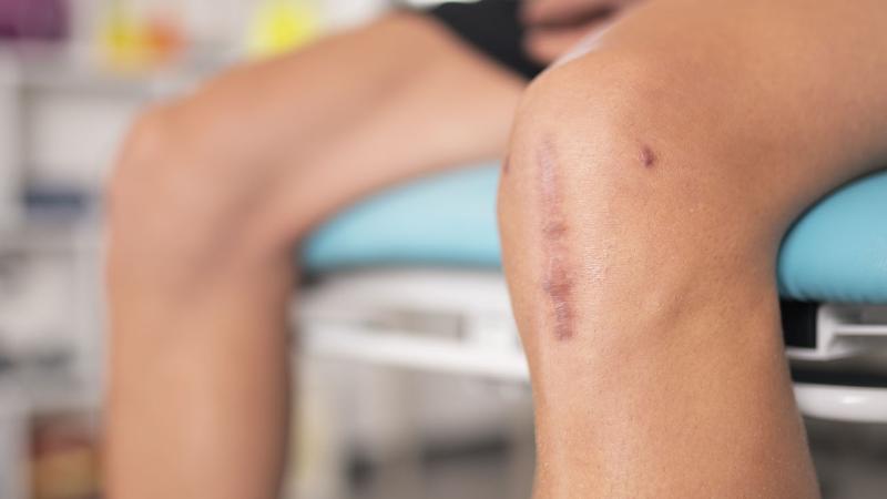 Photo of a knee with stitches.