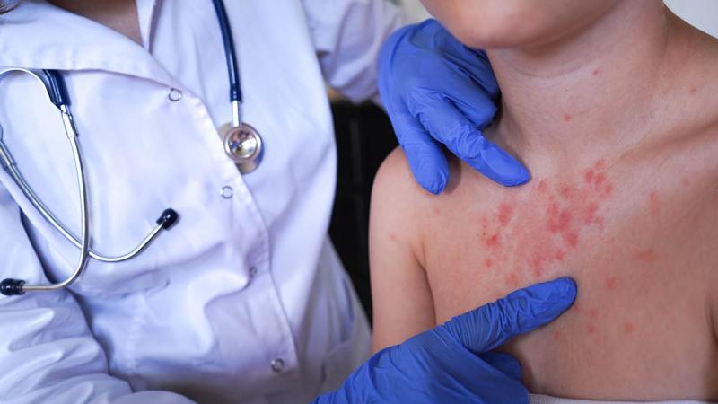 Doctor examining a patient with measles