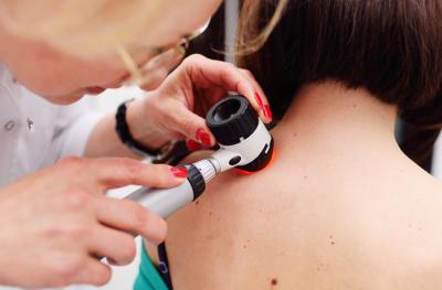 Doctors recommend people get their moles examined.
