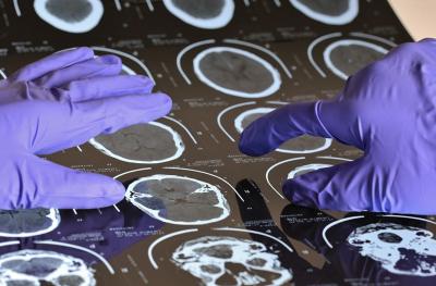 Photo of brain surgery