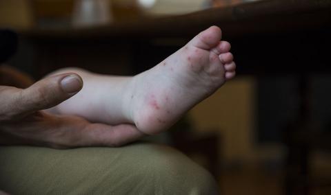 foot with rash