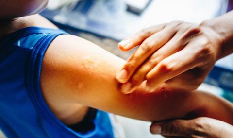 Insect bite on a child's arm