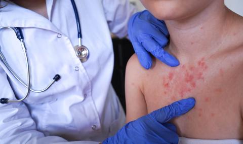 Doctor examining a patient with measles