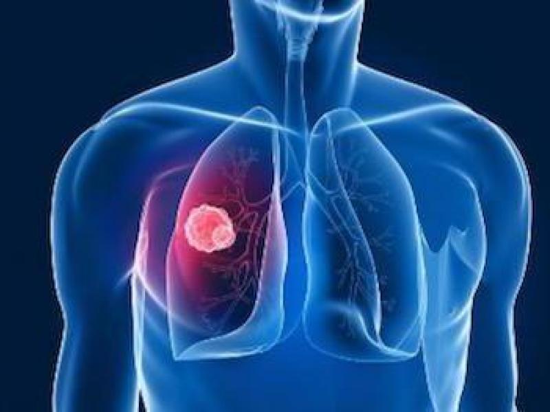 Lung Cancer