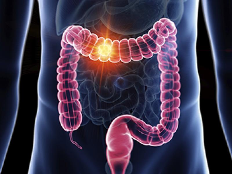 Colon Cancer illustration