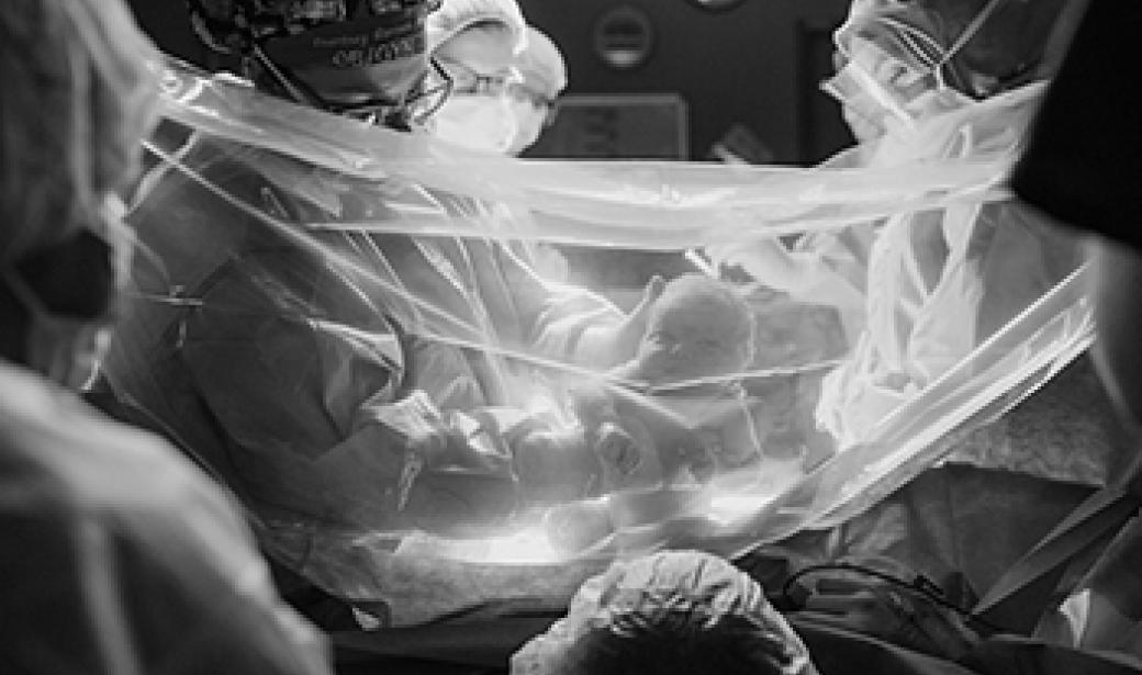 Photo of gentle c-section