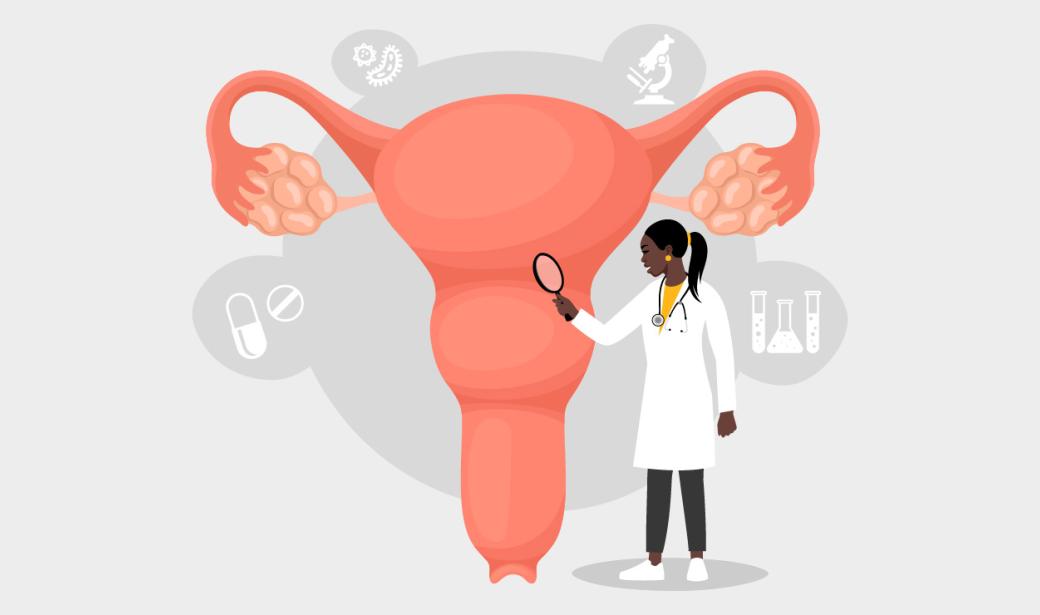Endometriosis graphic