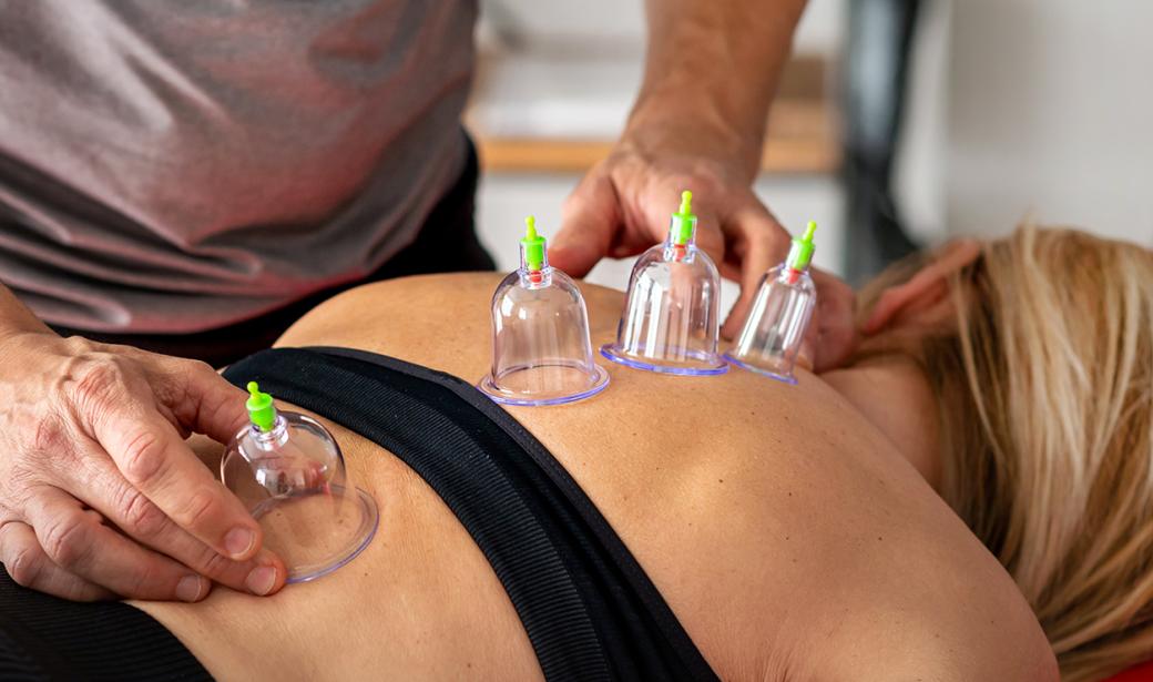 A photo of a woman receiving cupping therapy.