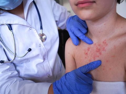 Measles Outbreak: Symptoms, Risks & Latest Updates 2024