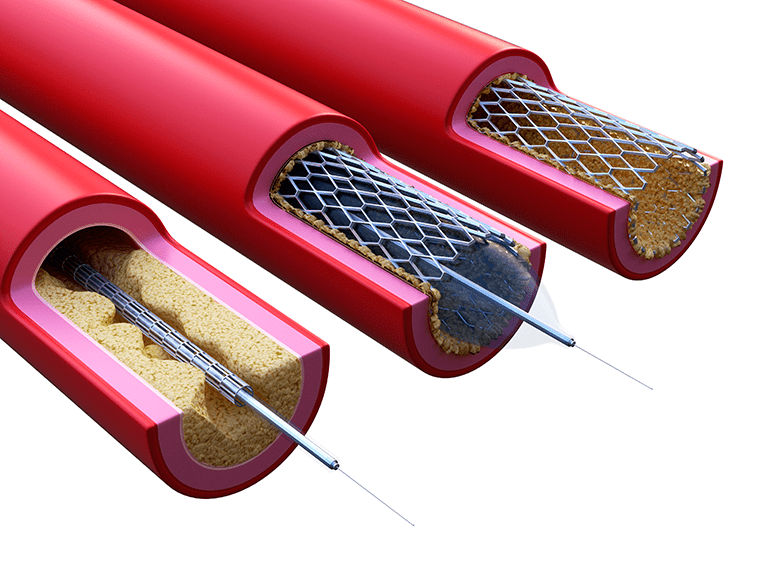 Illustration of a stent being placed