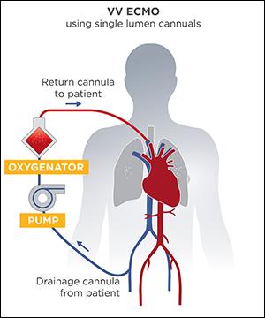 VV ECMO graphic