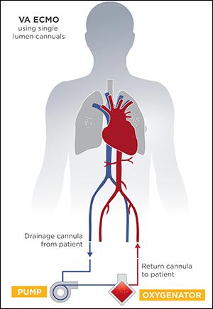 VA ECMO graphic