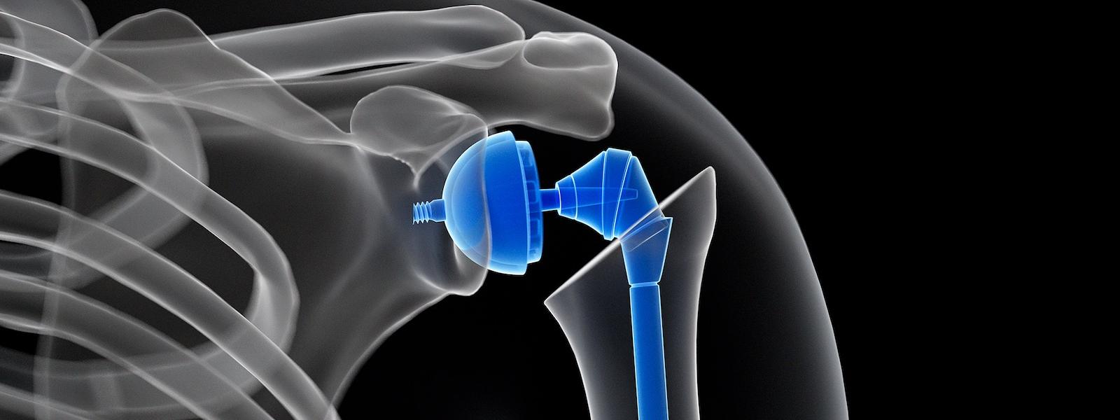 illustration of shoulder replacement