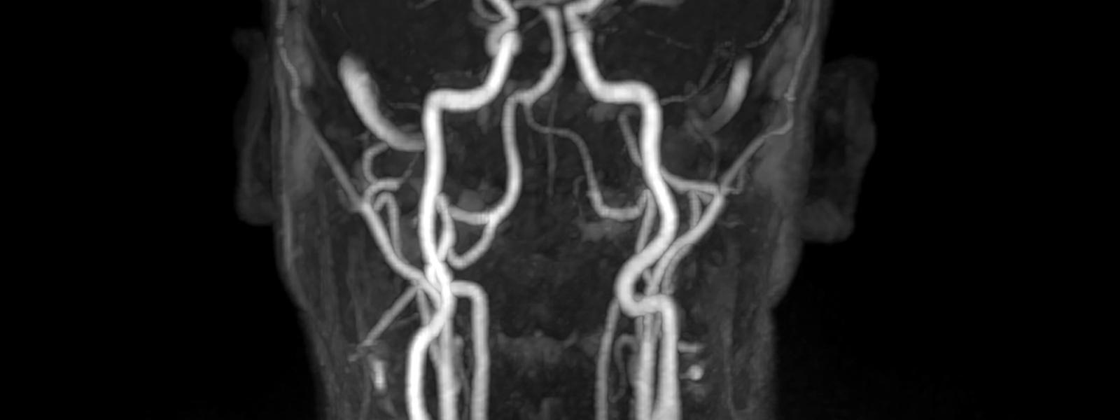 Imaging of arteries in the head